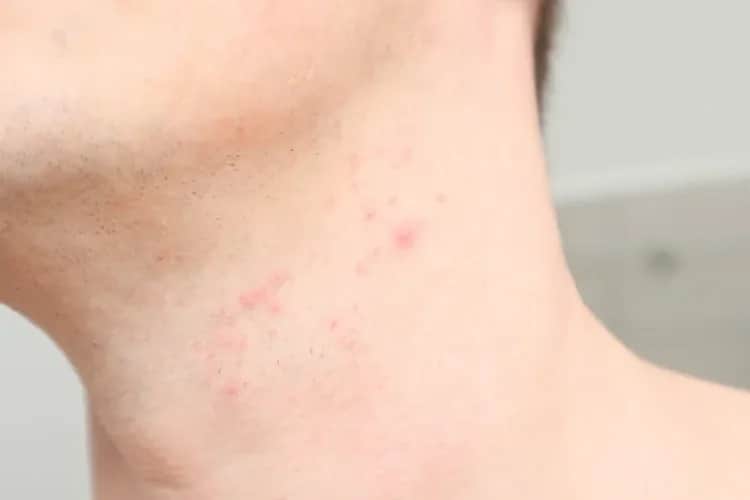 Problemy skórne po goleniu – jak sobie z nimi radzić?