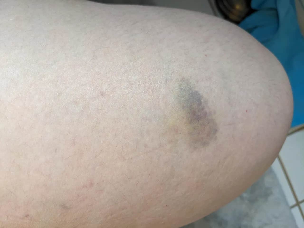 Siniak po tatuażu: Kiedy należy się martwić?