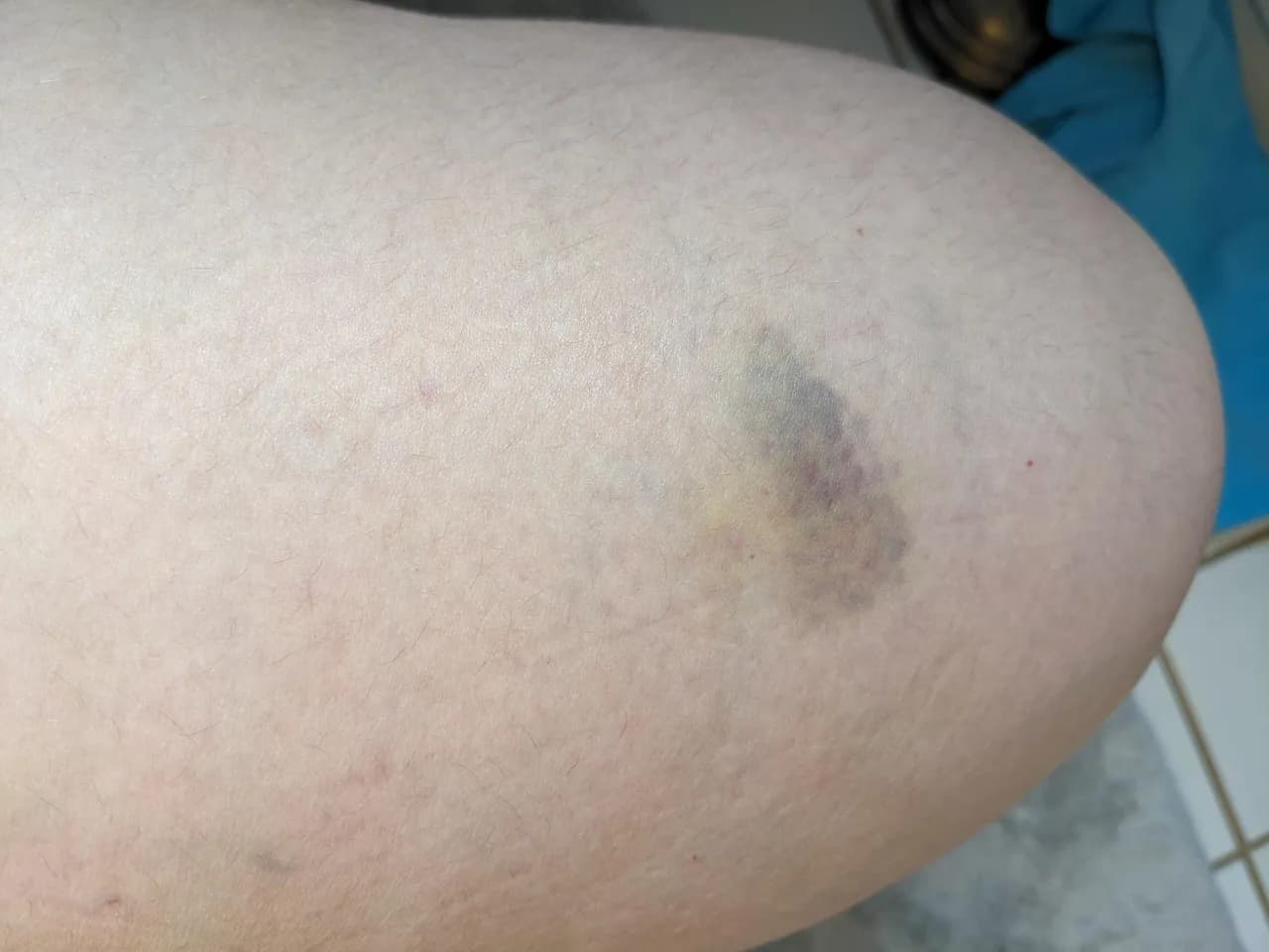 Siniak po tatuażu: Kiedy należy się martwić?